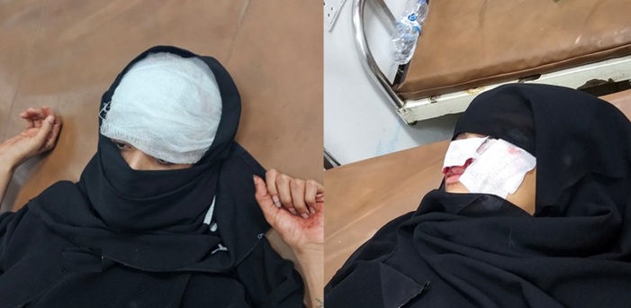 إصابة 3 فتيات بشظايا قذيفة حوثية انفجر جوار منزلهن في تعز