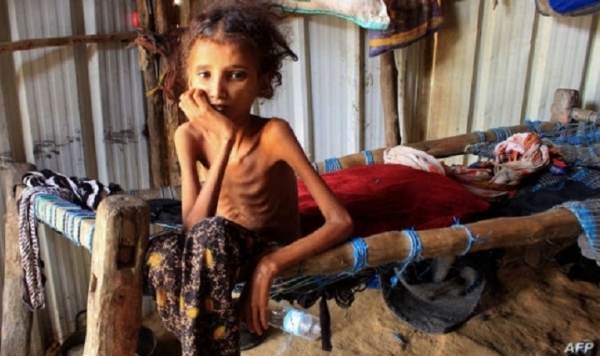 الأمم المتحدة: معدلات الجوع ارتفعت 10 أضعاف في عدة دول من بينها اليمن