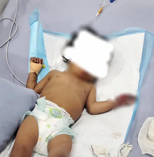 طفلة يمنية تتعرض لاصابات بليغة جراء انفجار جسم متفجر مزروع في هيئة لعبة اطفال